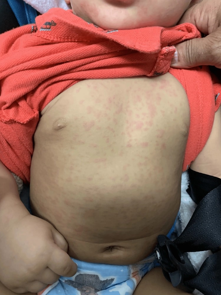 Розеола у ребенка. Фото: Micah Pippin и Gloria Laws, A Classic Presentation of Roseola Infantum, Cureus, 2024. Лицензия CC BY 4.0.