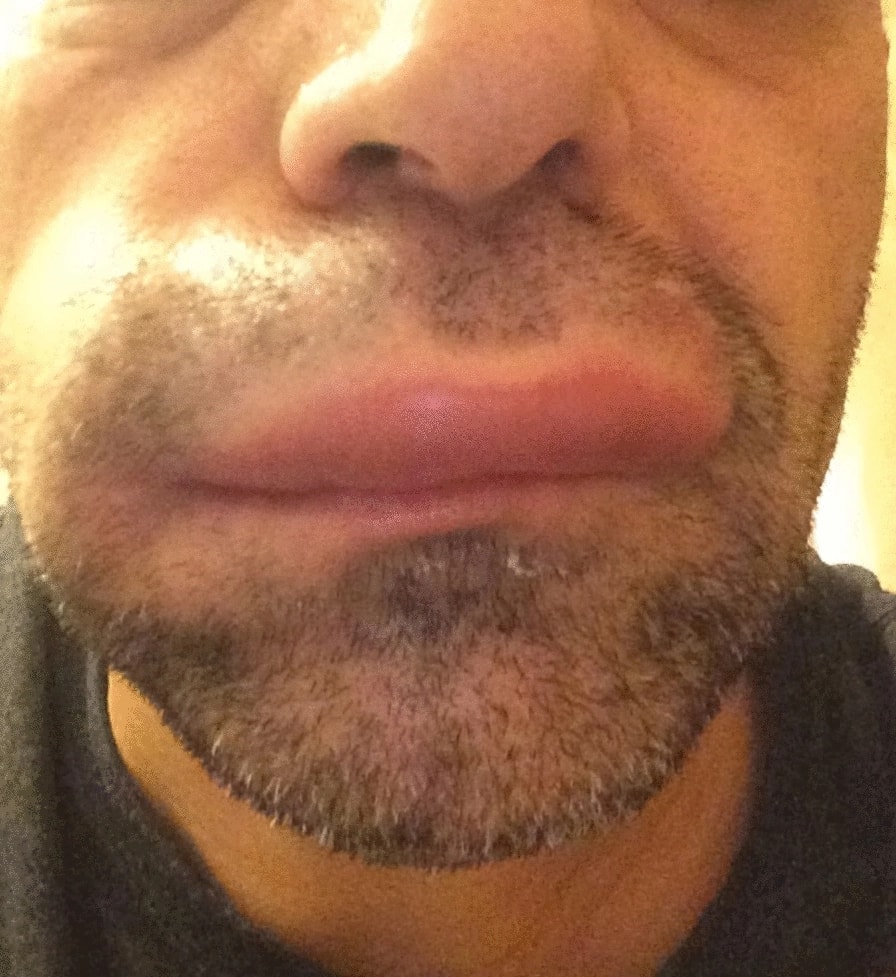 Ангиоотёк. Фото: Lacuesta G, et al. Angioedema. Allergy Asthma Clin Immunol. 2024;20(Suppl 3):65. CC BY 4.0.