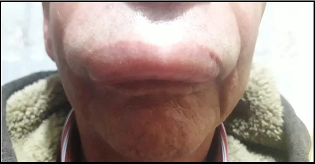 Брадикининовый отёк. Источник: Torres J, Torres J. Angioedema: A Case Report and Rev