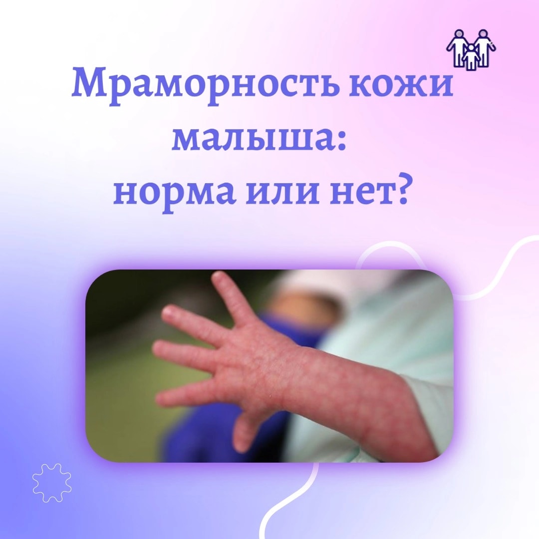 Мраморность кожи малыша: норма или нет?