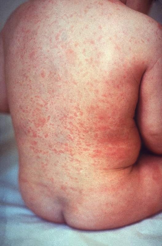 Краснуха у ребёнка: розовая пятнисто-папулёзная сыпь на спине. Фото: CDC, Public Domain. commons.wiki