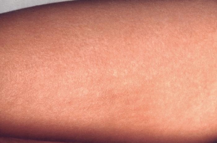 Скарлатина: мелкоточечная красная сыпь на предплечье. Фото: CDC Public Health Image Library, Public Domain.