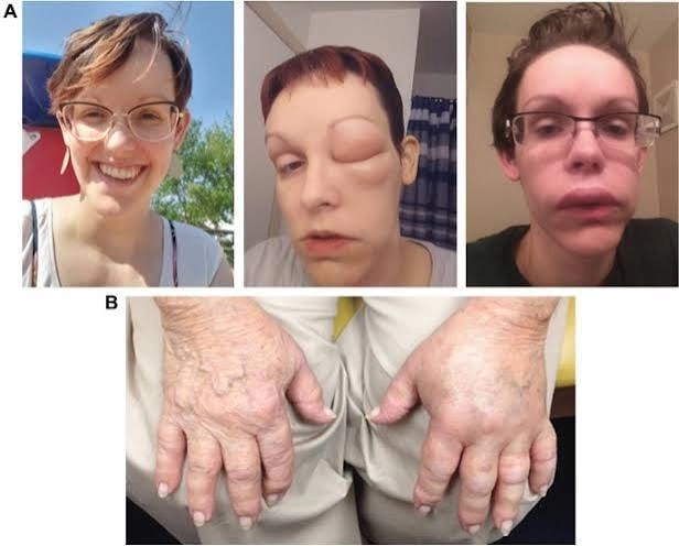 Наследственный ангиоотёк лица: отёк может нарастать постепенно и вовлекать губы, веки и щёки. Фото из Manning M.E., Recognition and Manageme